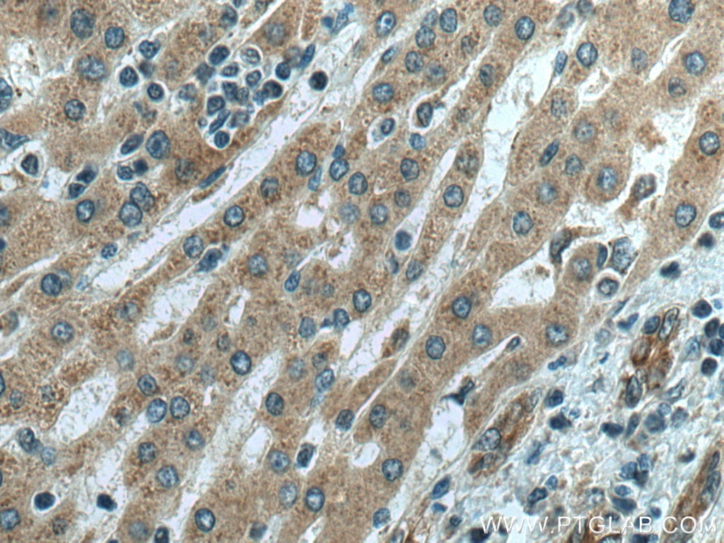 Immunohistochemistry (IHC) staining of human liver cancer tissue using SLC12A4 Polyclonal antibody (15927-1-AP)