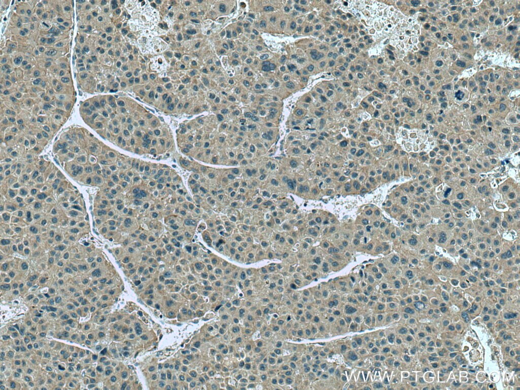 Immunohistochemistry (IHC) staining of human liver cancer tissue using SLC12A4 Polyclonal antibody (15927-1-AP)