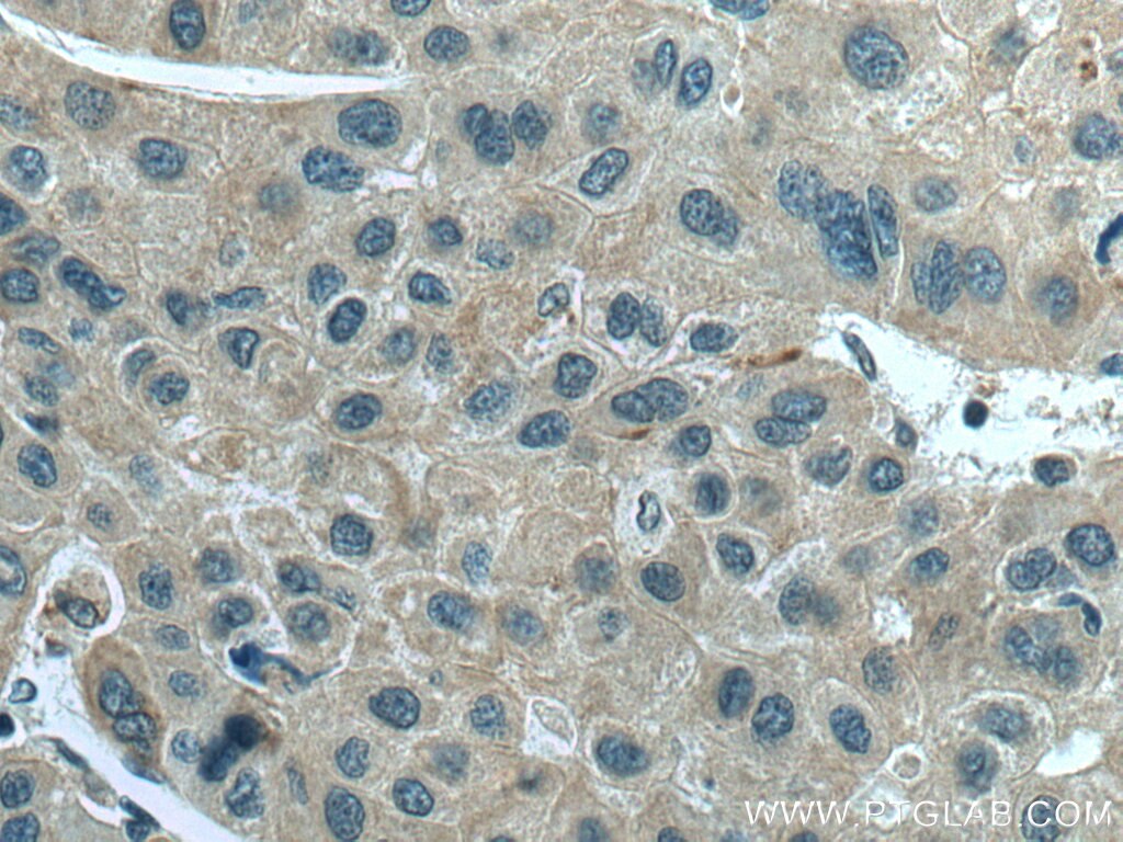 Immunohistochemistry (IHC) staining of human liver cancer tissue using SLC12A4 Polyclonal antibody (15927-1-AP)