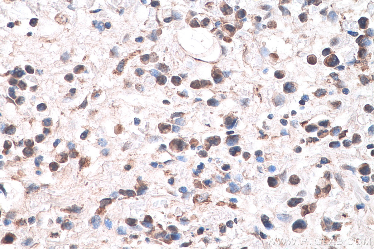Immunohistochemistry (IHC) staining of human stomach cancer tissue using SLC16A12 Polyclonal antibody (20553-1-AP)