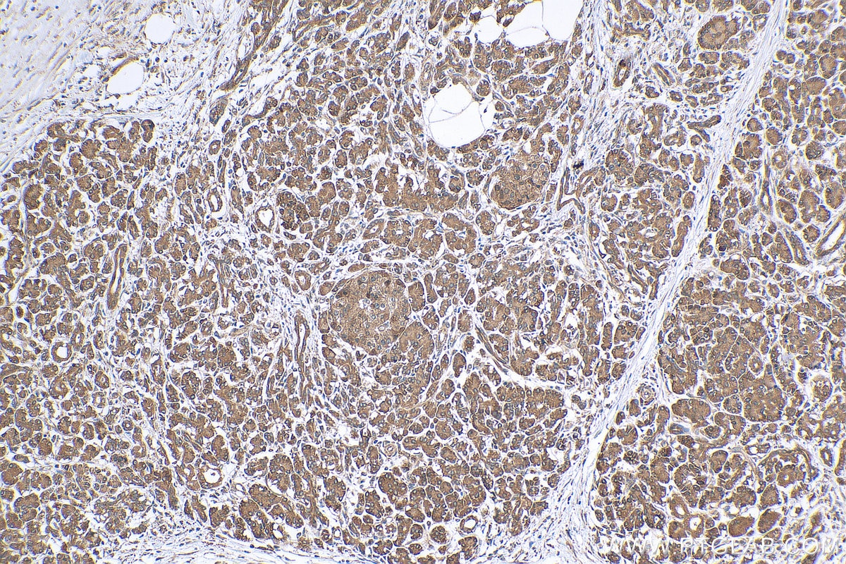 Immunohistochemistry (IHC) staining of human pancreas cancer tissue using SLC16A13 Polyclonal antibody (30466-1-AP)