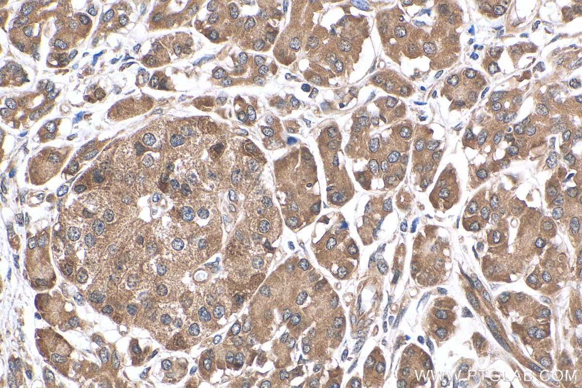 Immunohistochemistry (IHC) staining of human pancreas cancer tissue using SLC16A13 Polyclonal antibody (30466-1-AP)