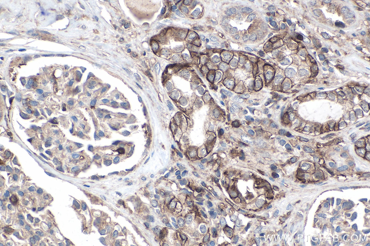 Immunohistochemistry (IHC) staining of human renal cell carcinoma tissue using MCT4 Polyclonal antibody (22787-1-AP)
