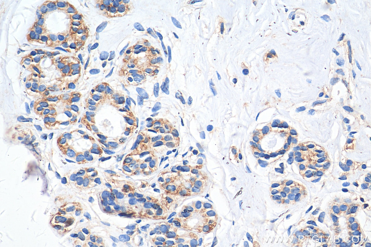 Immunohistochemistry (IHC) staining of human breast cancer tissue using MCT4 Polyclonal antibody (22787-1-AP)