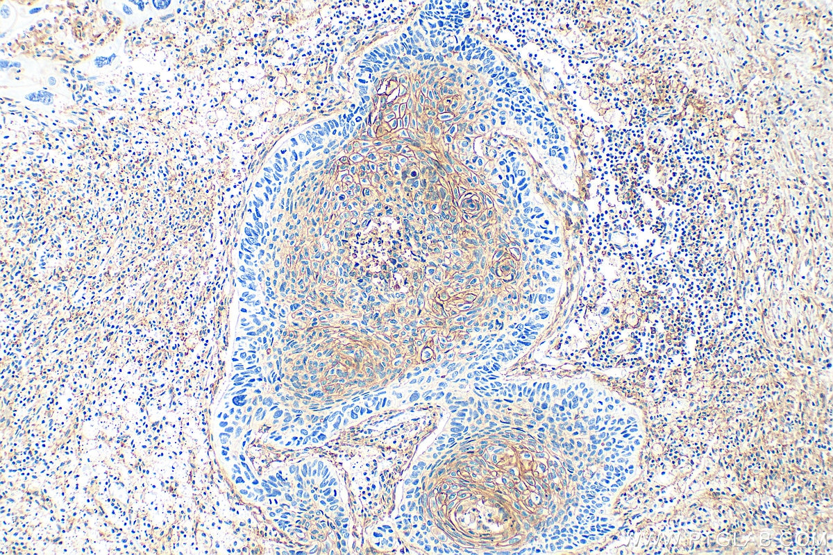 Immunohistochemistry (IHC) staining of human lung cancer tissue using MCT4 Polyclonal antibody (22787-1-AP)