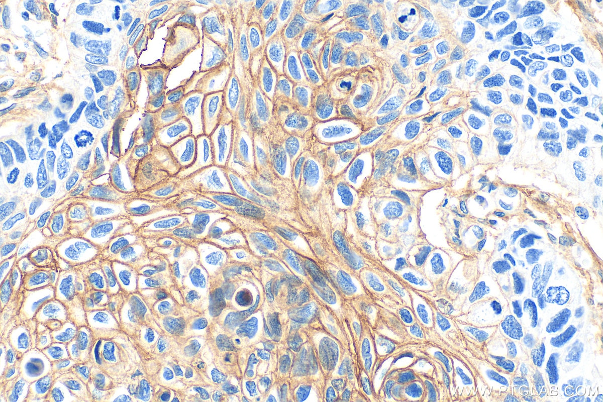 Immunohistochemistry (IHC) staining of human lung cancer tissue using MCT4 Polyclonal antibody (22787-1-AP)