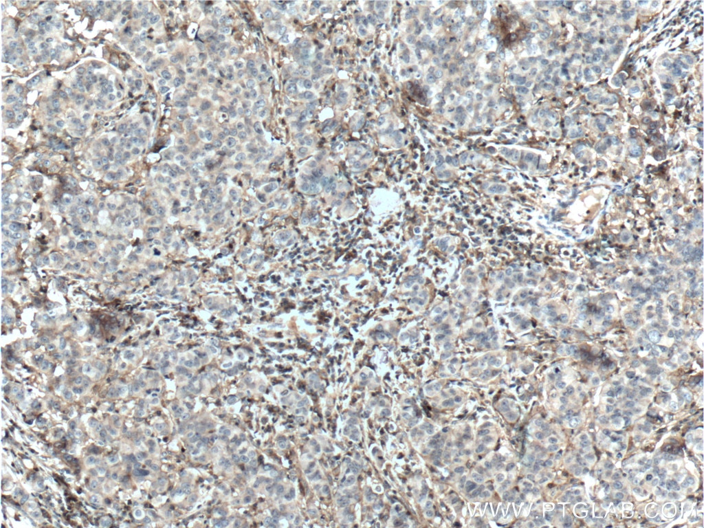 Immunohistochemistry (IHC) staining of human prostate cancer tissue using MCT4 Polyclonal antibody (22787-1-AP)