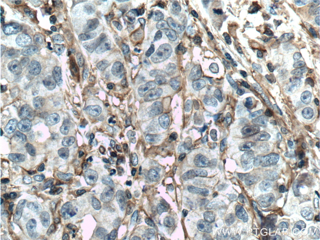 Immunohistochemistry (IHC) staining of human prostate cancer tissue using MCT4 Polyclonal antibody (22787-1-AP)