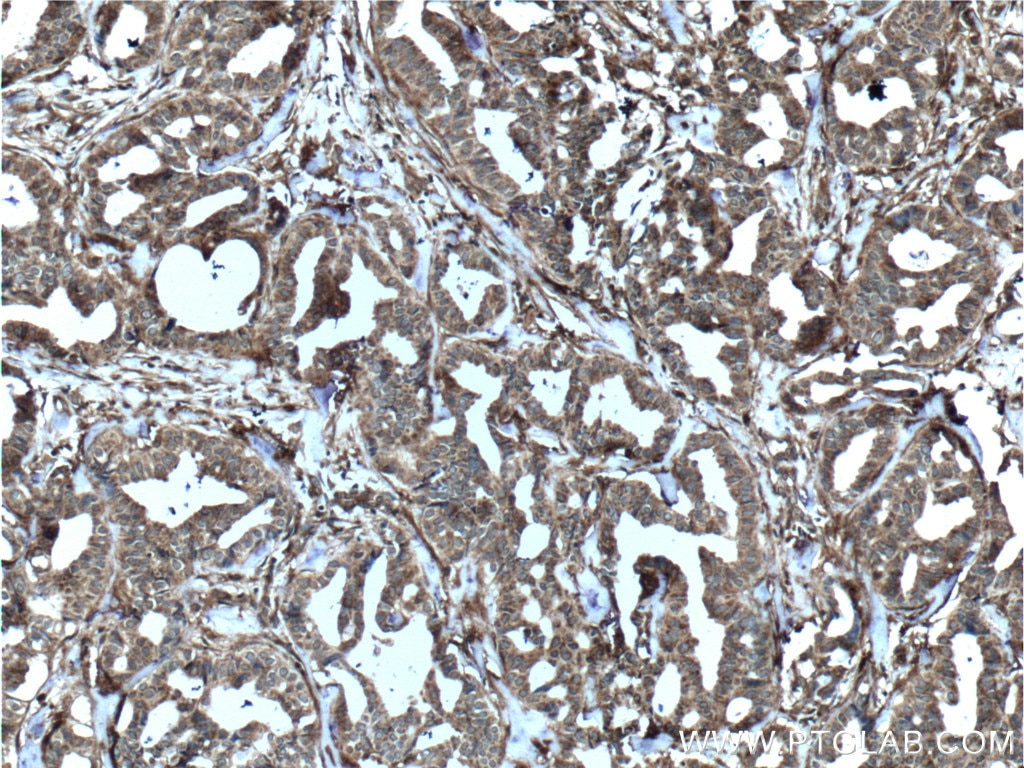 Immunohistochemistry (IHC) staining of human breast cancer tissue using MCT4 Polyclonal antibody (22787-1-AP)