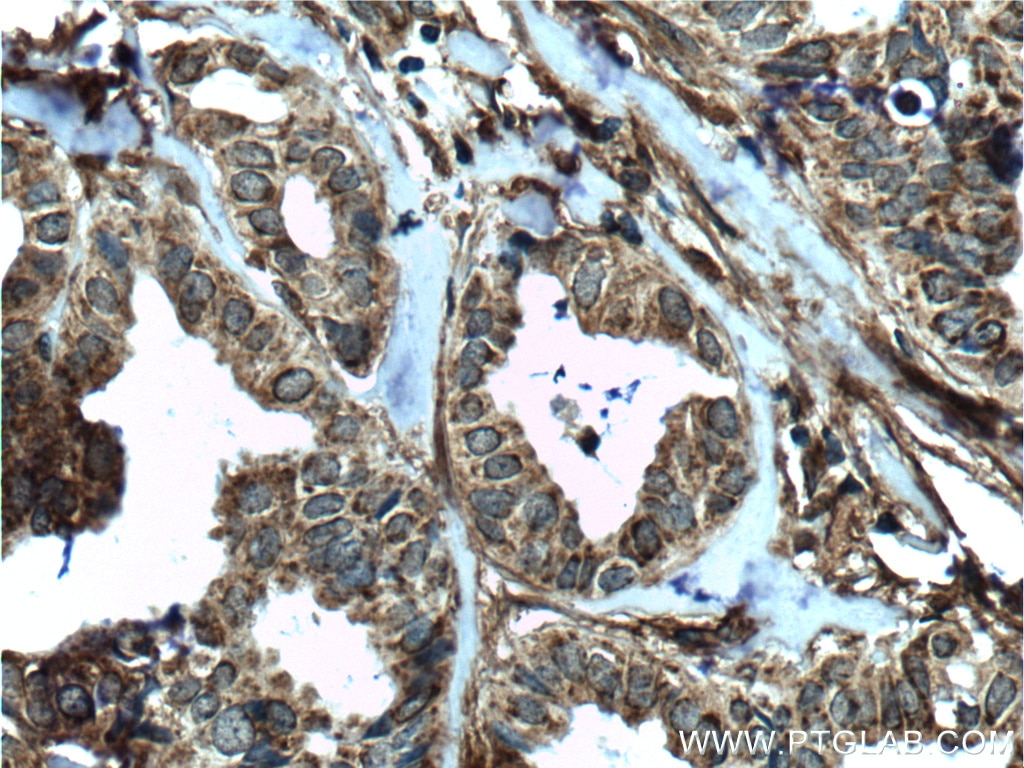 Immunohistochemistry (IHC) staining of human breast cancer tissue using MCT4 Polyclonal antibody (22787-1-AP)