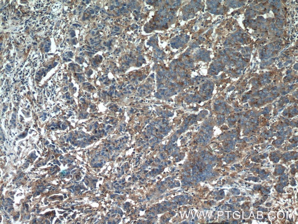 Immunohistochemistry (IHC) staining of human prostate cancer tissue using MCT4 Polyclonal antibody (22787-1-AP)