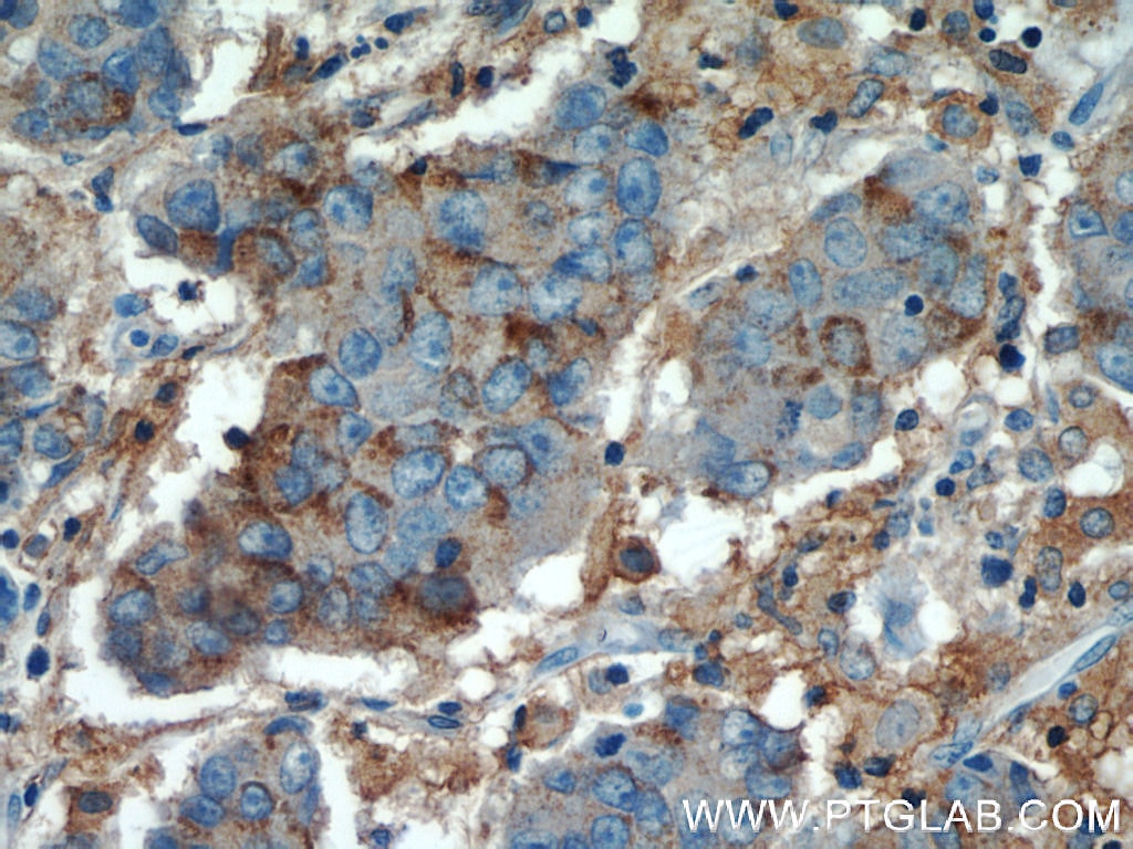 Immunohistochemistry (IHC) staining of human prostate cancer tissue using MCT4 Polyclonal antibody (22787-1-AP)