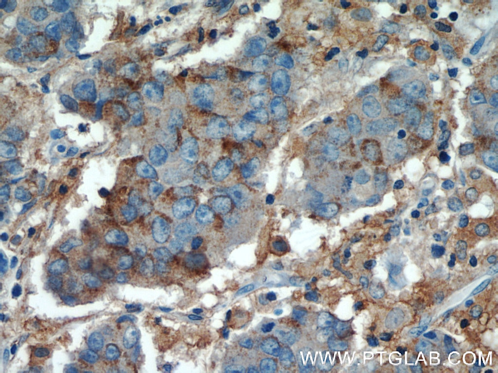 IHC staining of human prostate cancer using 22787-1-AP