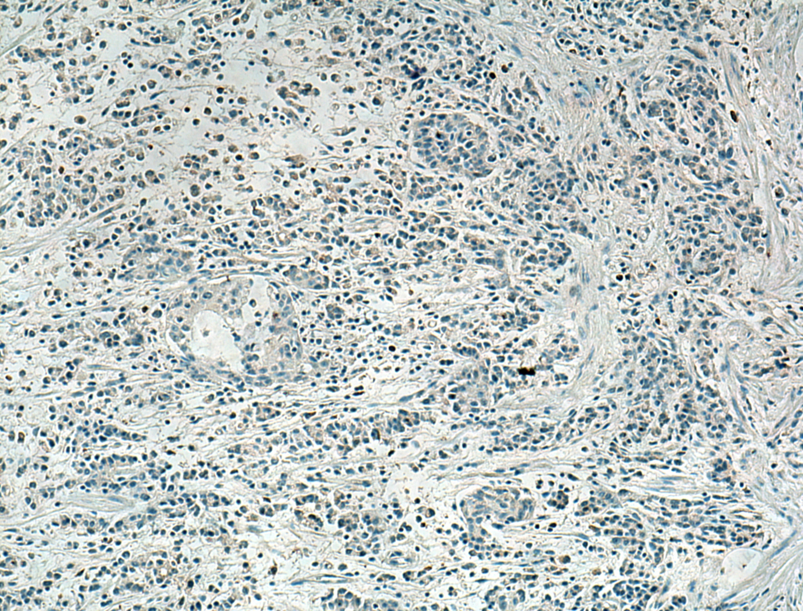 Immunohistochemistry (IHC) staining of human stomach cancer tissue using SLC16A4 Polyclonal antibody (20889-1-AP)