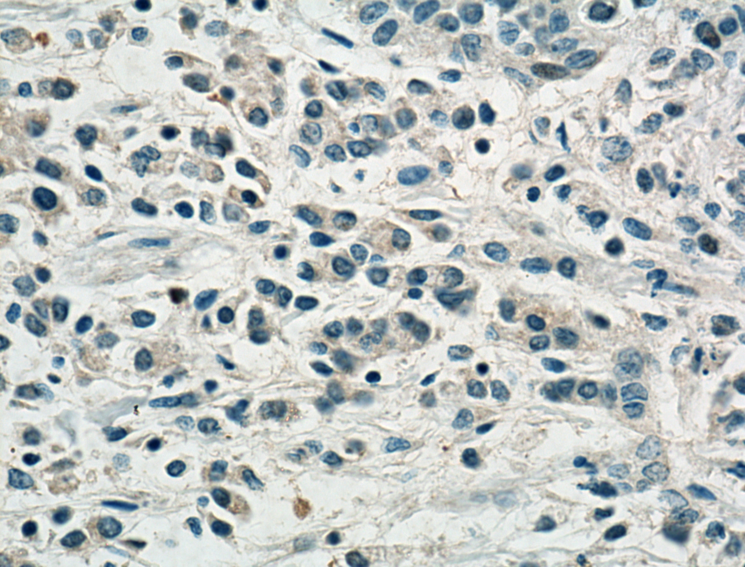 Immunohistochemistry (IHC) staining of human stomach cancer tissue using SLC16A4 Polyclonal antibody (20889-1-AP)