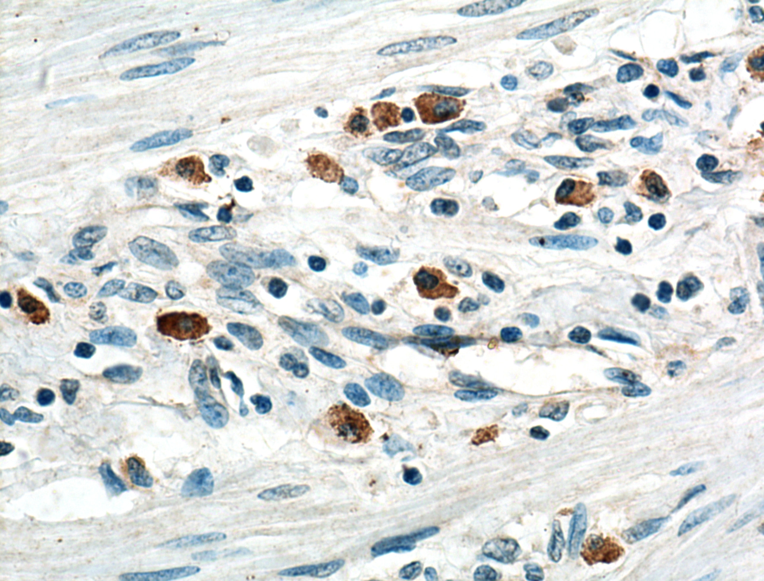 Immunohistochemistry (IHC) staining of human stomach cancer tissue using SLC16A4 Polyclonal antibody (20889-1-AP)