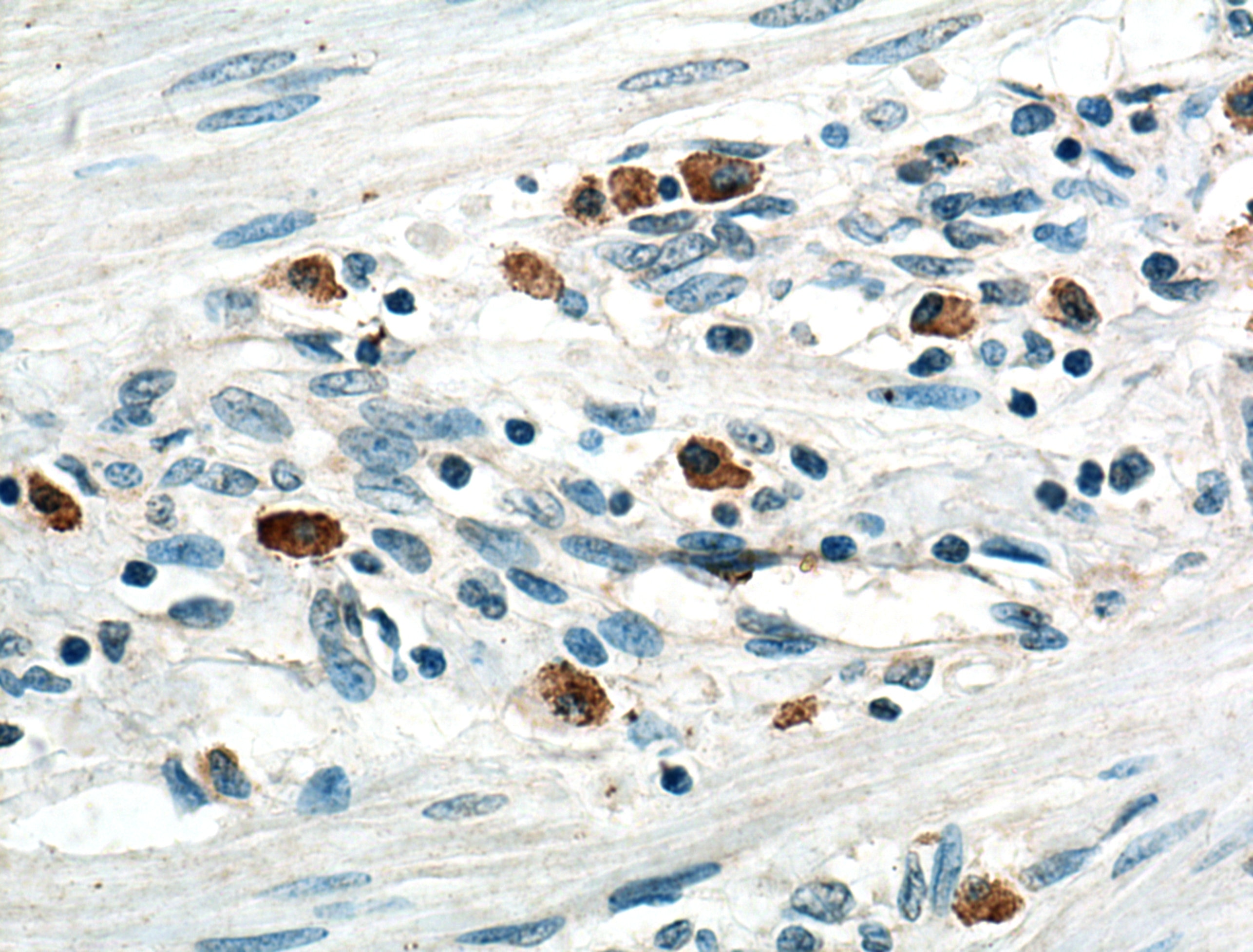 IHC staining of human stomach cancer using 20889-1-AP