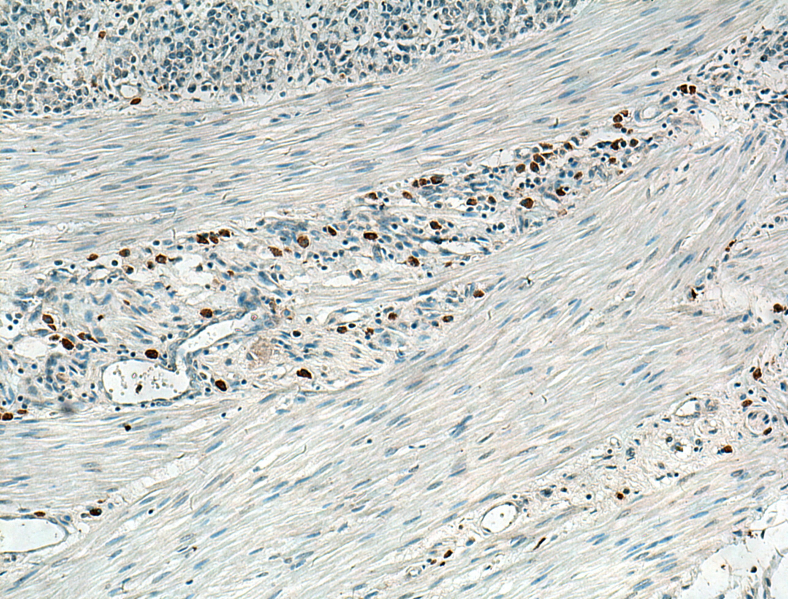 Immunohistochemistry (IHC) staining of human stomach cancer tissue using SLC16A4 Polyclonal antibody (20889-1-AP)