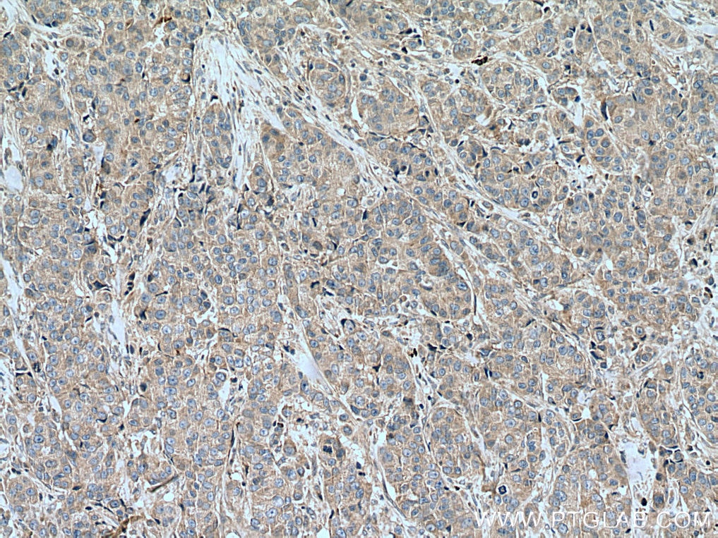Immunohistochemistry (IHC) staining of human breast cancer tissue using SLC16A5 Polyclonal antibody (12120-1-AP)