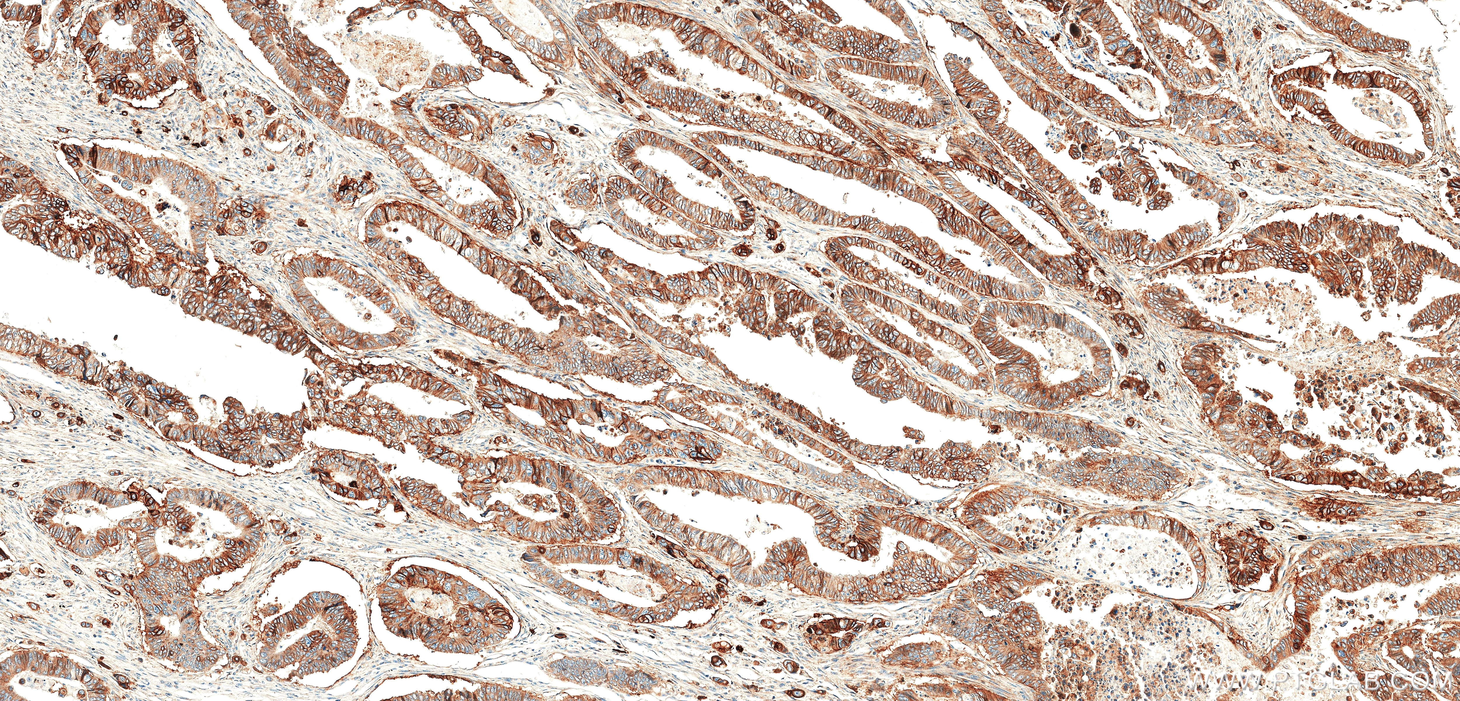 Immunohistochemistry (IHC) staining of human colon cancer tissue using SLC1A5/ASCT2 Recombinant monoclonal antibody (87833-2-RR)