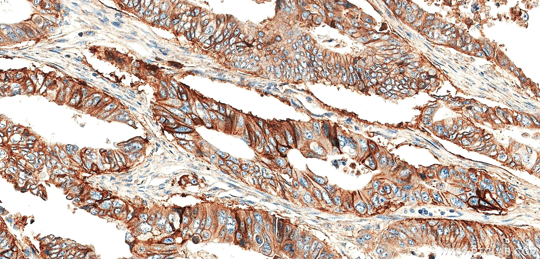 Immunohistochemistry (IHC) staining of human colon cancer tissue using SLC1A5/ASCT2 Recombinant monoclonal antibody (87833-2-RR)
