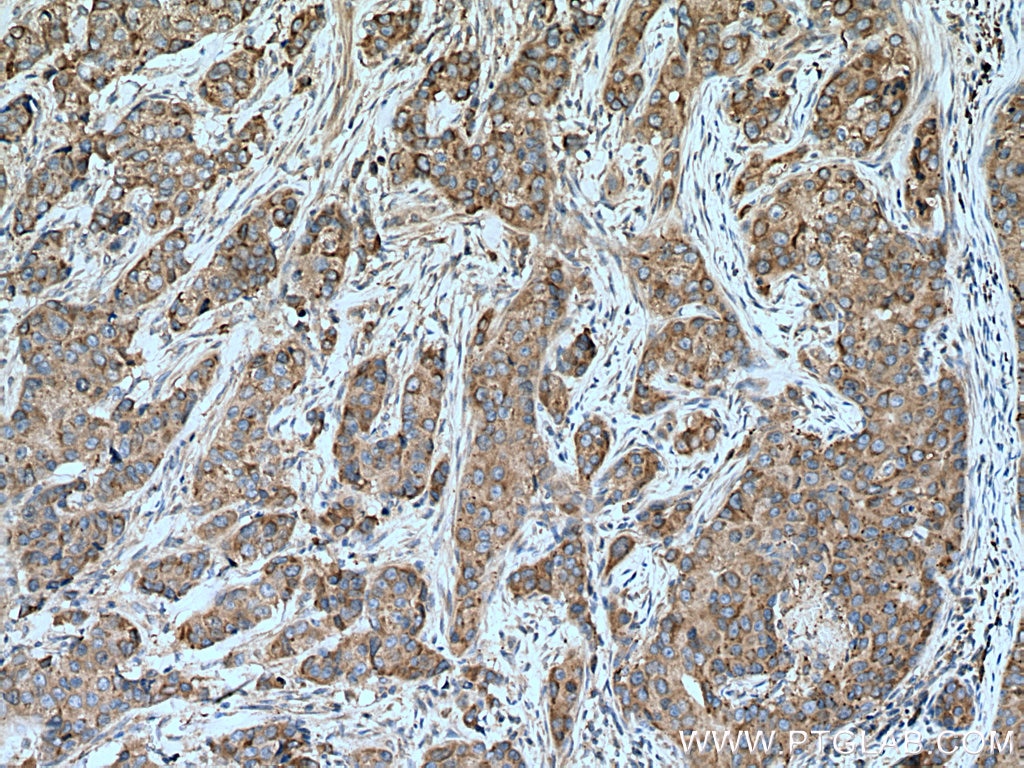 Immunohistochemistry (IHC) staining of human breast cancer tissue using SLC20A1 Polyclonal antibody (12423-1-AP)