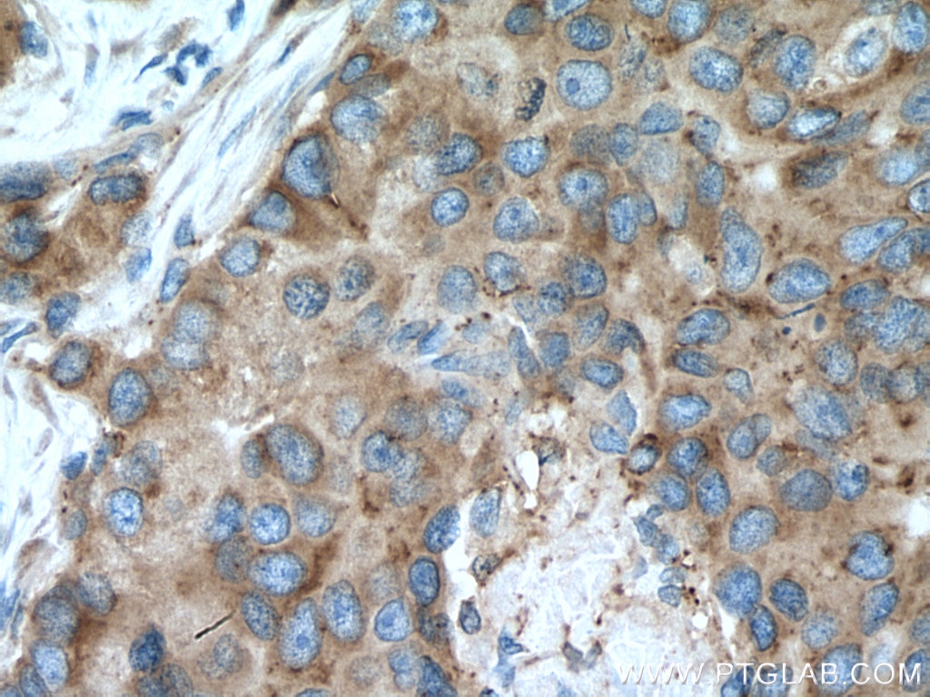 Immunohistochemistry (IHC) staining of human breast cancer tissue using SLC20A1 Polyclonal antibody (12423-1-AP)