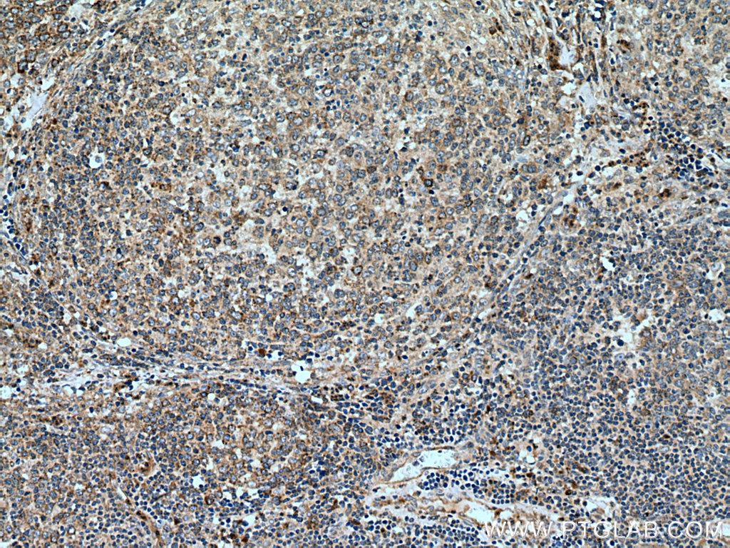 Immunohistochemistry (IHC) staining of human lymphoma tissue using SLC20A1 Polyclonal antibody (12423-1-AP)