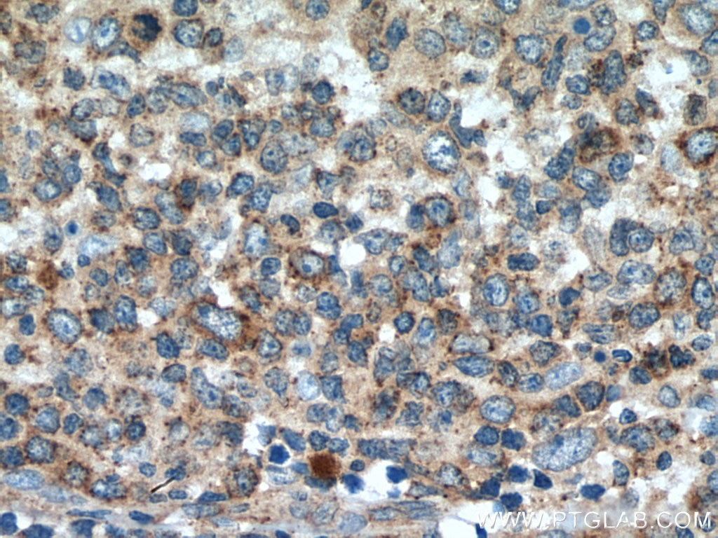Immunohistochemistry (IHC) staining of human lymphoma tissue using SLC20A1 Polyclonal antibody (12423-1-AP)