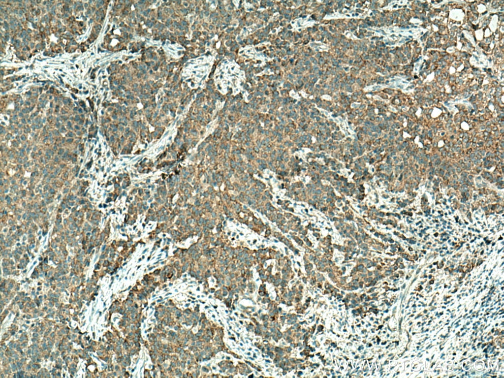 Immunohistochemistry (IHC) staining of human stomach cancer tissue using SLC22A16 Polyclonal antibody (26833-1-AP)