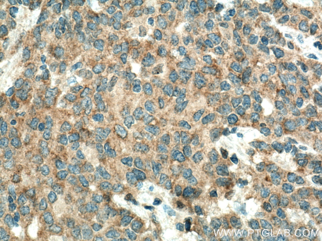 Immunohistochemistry (IHC) staining of human stomach cancer tissue using SLC22A16 Polyclonal antibody (26833-1-AP)