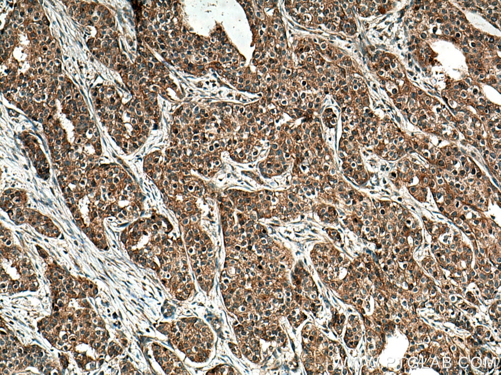 Immunohistochemistry (IHC) staining of human breast cancer tissue using SLC22A16 Polyclonal antibody (26833-1-AP)