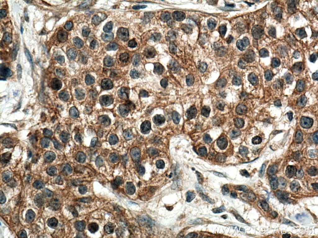 Immunohistochemistry (IHC) staining of human breast cancer tissue using SLC22A16 Polyclonal antibody (26833-1-AP)