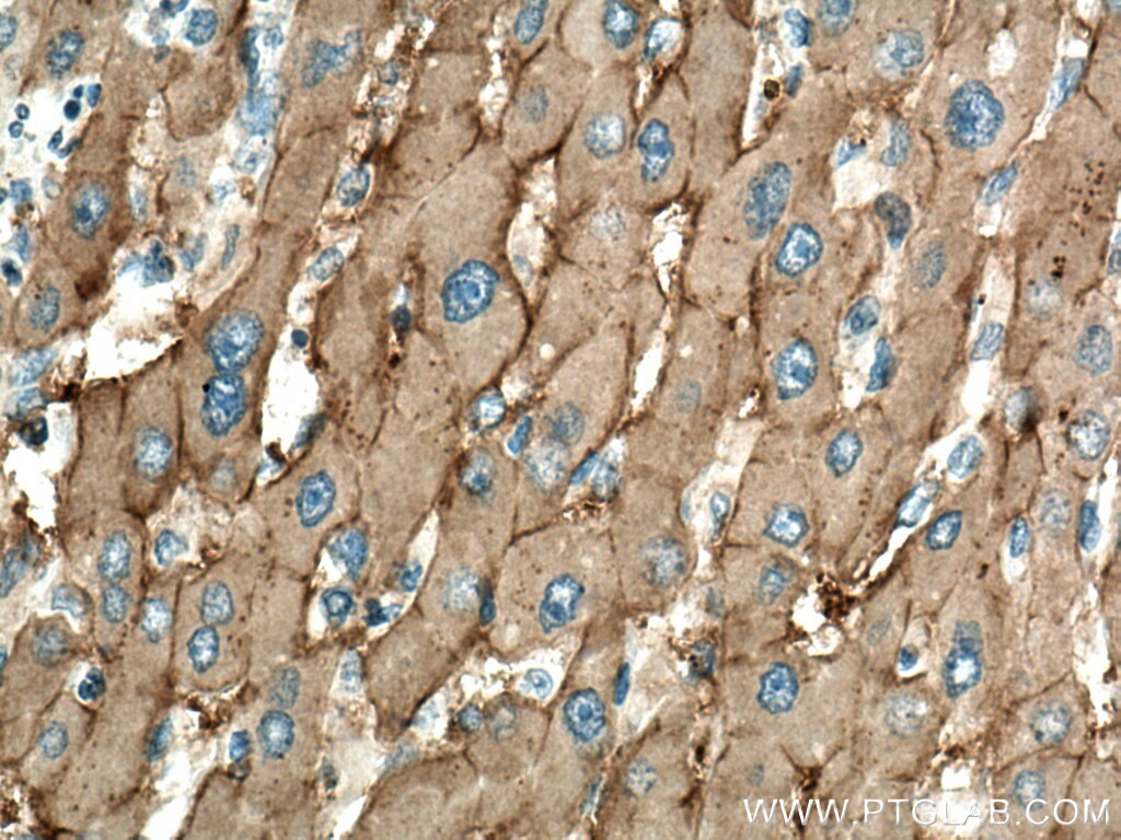 Immunohistochemistry (IHC) staining of human liver cancer tissue using SLC22A7 Monoclonal antibody (67479-1-Ig)