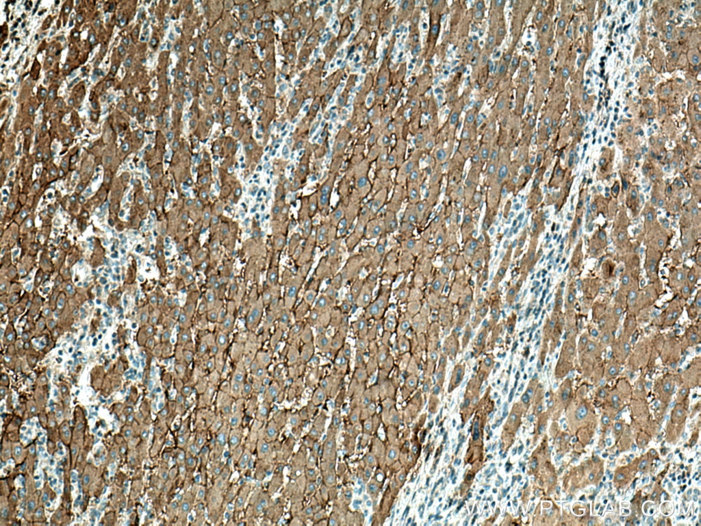 Immunohistochemistry (IHC) staining of human liver cancer tissue using SLC22A7 Monoclonal antibody (67479-1-Ig)