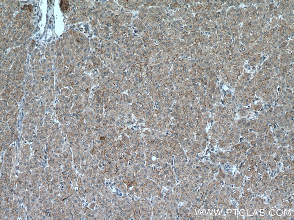 Immunohistochemistry (IHC) staining of human liver cancer tissue using SLC22A9 Polyclonal antibody (27998-1-AP)