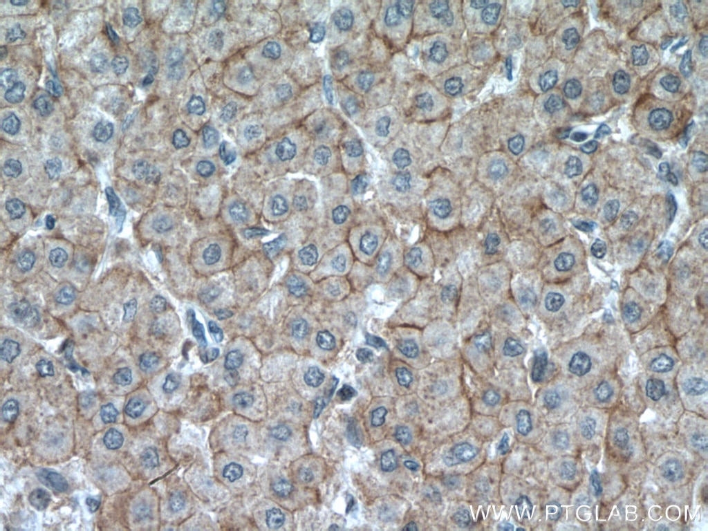 Immunohistochemistry (IHC) staining of human liver cancer tissue using SLC22A9 Polyclonal antibody (27998-1-AP)