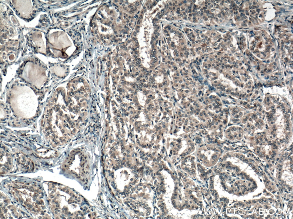 Immunohistochemistry (IHC) staining of human thyroid cancer tissue using SLC24A5 Polyclonal antibody (27747-1-AP)