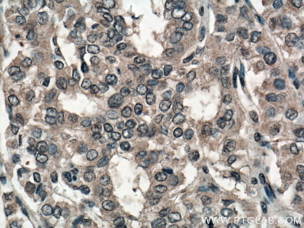 Immunohistochemistry (IHC) staining of human thyroid cancer tissue using SLC24A5 Polyclonal antibody (27747-1-AP)