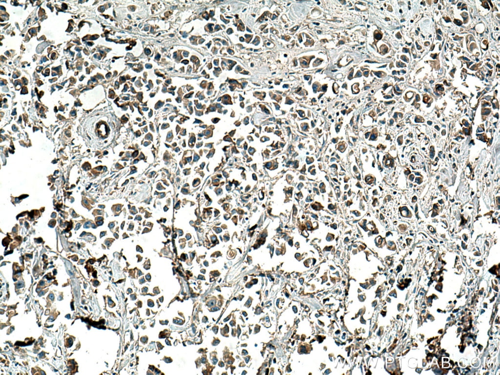 Immunohistochemistry (IHC) staining of human breast cancer tissue using SLC25A1 Polyclonal antibody (15235-1-AP)