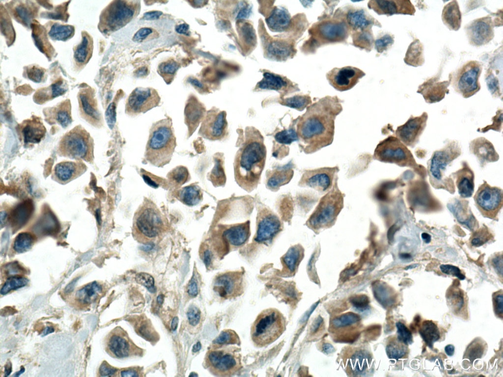Immunohistochemistry (IHC) staining of human breast cancer tissue using SLC25A1 Polyclonal antibody (15235-1-AP)