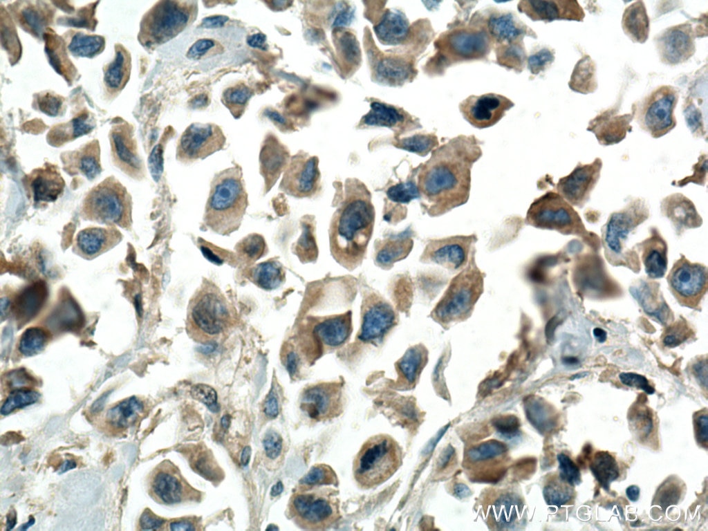 IHC staining of human breast cancer using 15235-1-AP