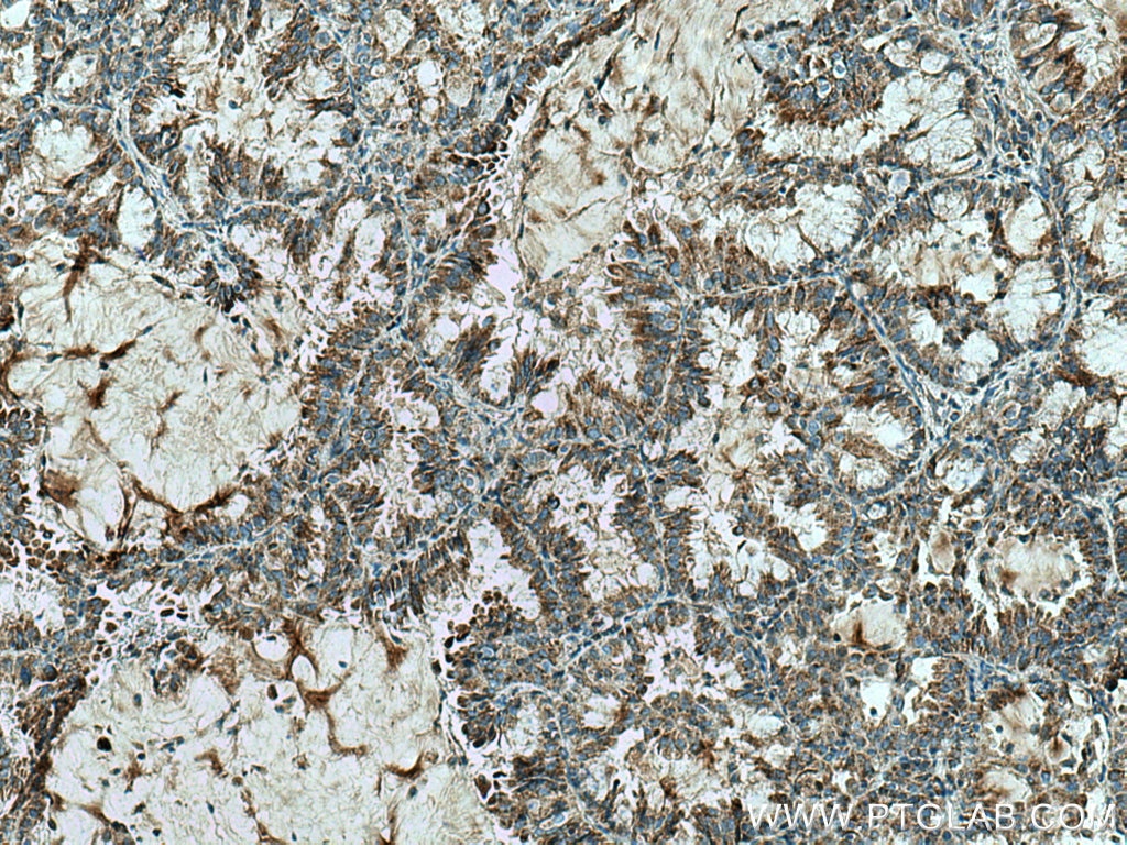 Immunohistochemistry (IHC) staining of human lung cancer tissue using SLC25A1 Polyclonal antibody (15235-1-AP)
