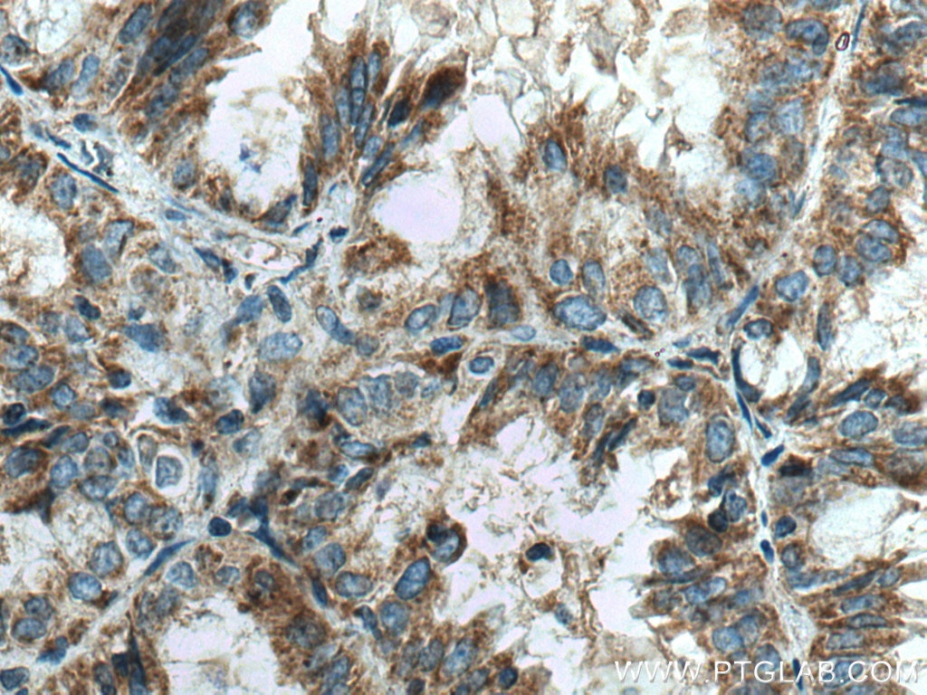 Immunohistochemistry (IHC) staining of human lung cancer tissue using SLC25A1 Polyclonal antibody (15235-1-AP)