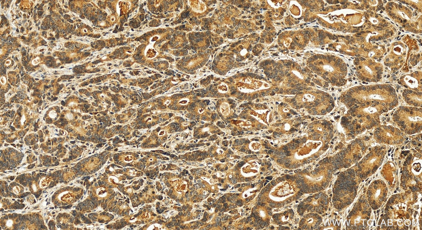 Immunohistochemistry (IHC) staining of human stomach cancer tissue using SLC25A11 Polyclonal antibody (12253-1-AP)