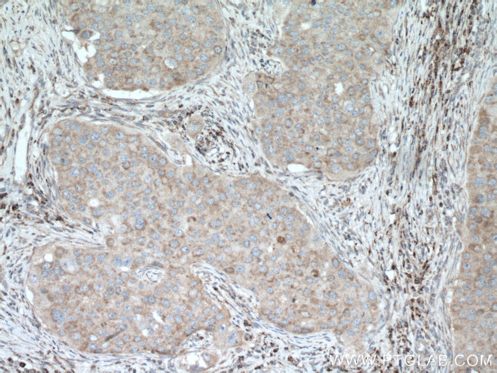 IHC staining of human breast cancer using 26804-1-AP