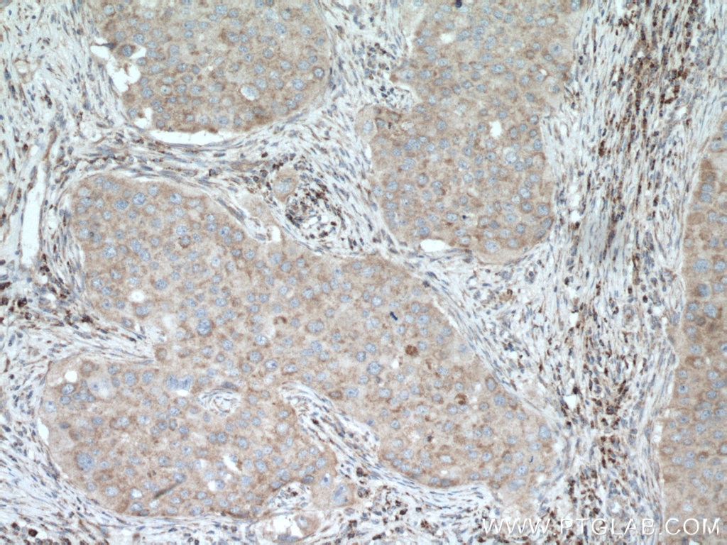 Immunohistochemistry (IHC) staining of human breast cancer tissue using SLC25A12 Polyclonal antibody (26804-1-AP)