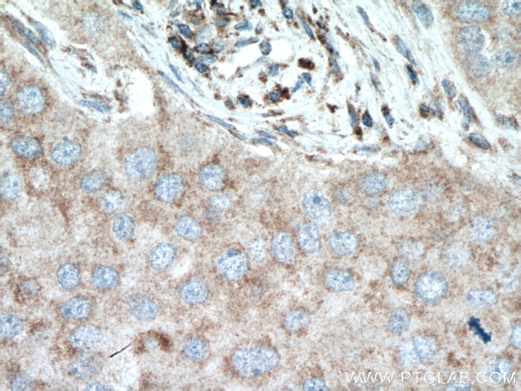 Immunohistochemistry (IHC) staining of human breast cancer tissue using SLC25A12 Polyclonal antibody (26804-1-AP)