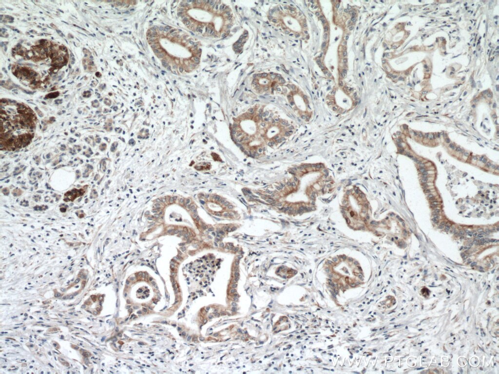 IHC staining of human pancreas cancer using 26804-1-AP