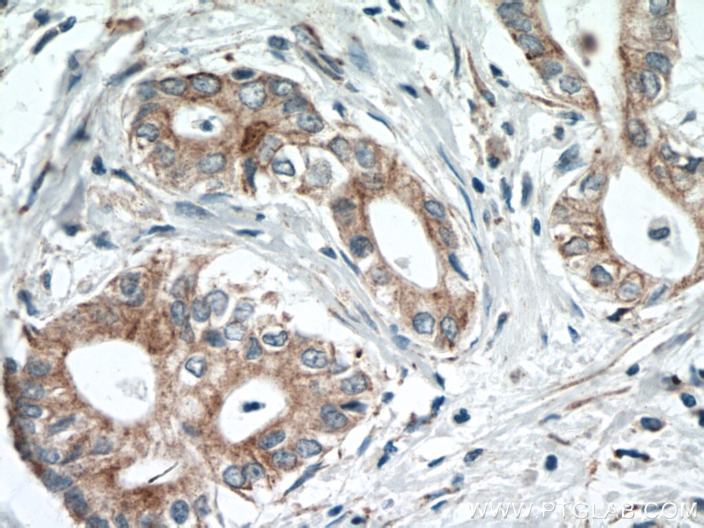 Immunohistochemistry (IHC) staining of human pancreas cancer tissue using SLC25A12 Polyclonal antibody (26804-1-AP)